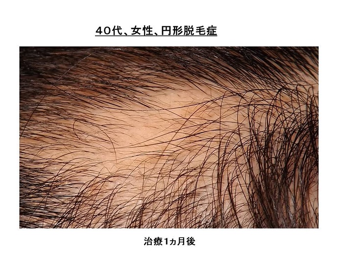 円形脱毛症　病院""